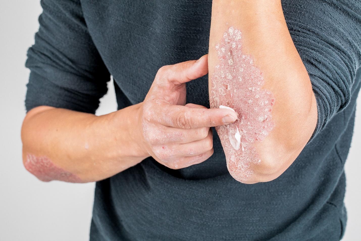 Psoriasis Treatment in Ludhiana