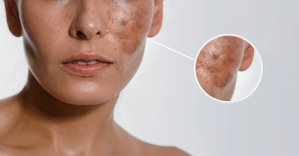 Best Dermatologist in Ludhiana for Acne