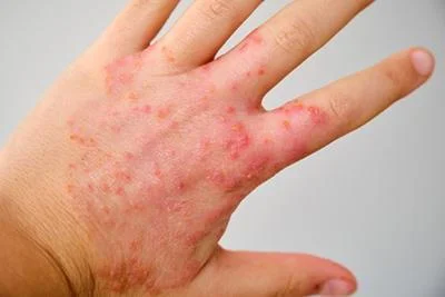 Eczema Treatment in Ludhiana