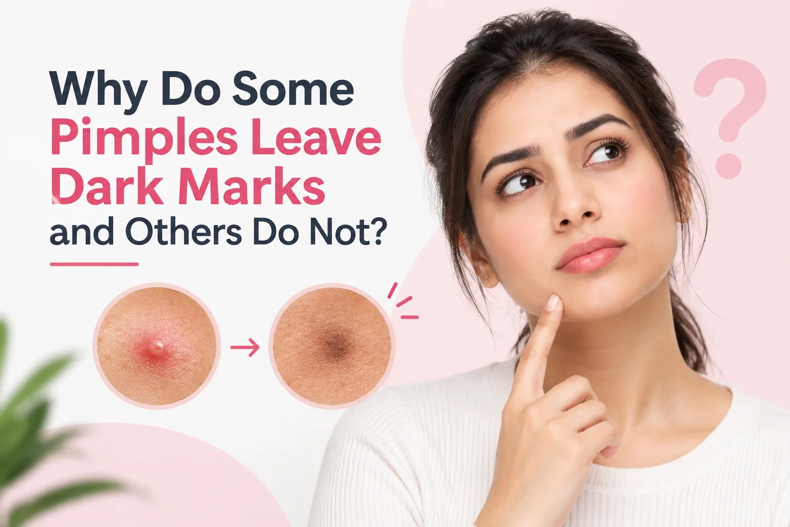 Acne Dark Marks